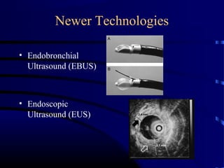 Newer Technologies
• Endobronchial
Ultrasound (EBUS)
• Endoscopic
Ultrasound (EUS)
 