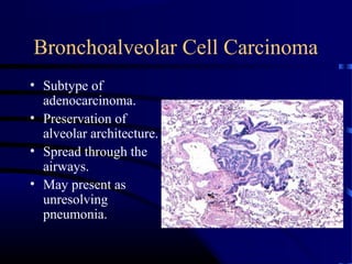 Bronchoalveolar Cell Carcinoma
• Subtype of
adenocarcinoma.
• Preservation of
alveolar architecture.
• Spread through the
airways.
• May present as
unresolving
pneumonia.
 