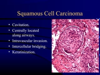 Squamous Cell Carcinoma
• Cavitation.
• Centrally located
along airways.
• Intravascular invasion.
• Intercellular bridging.
• Keratinization.
 