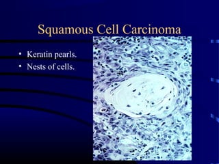 Squamous Cell Carcinoma
• Keratin pearls.
• Nests of cells.
 