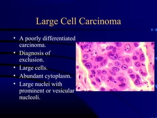 Large Cell Carcinoma
• A poorly differentiated
carcinoma.
• Diagnosis of
exclusion.
• Large cells.
• Abundant cytoplasm.
• Large nuclei with
prominent or vesicular
nucleoli.
 