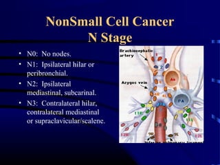 NonSmall Cell Cancer
N Stage
• N0: No nodes.
• N1: Ipsilateral hilar or
peribronchial.
• N2: Ipsilateral
mediastinal, subcarinal.
• N3: Contralateral hilar,
contralateral mediastinal
or supraclavicular/scalene.
 