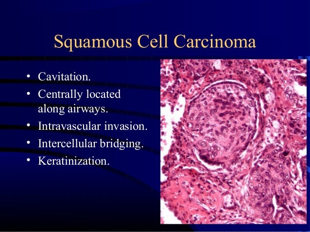 Lung Cancer: Diagnosis, Staging, and Treatment