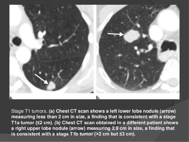 Cm 11 Stage T1 Tumors Cm 11 Stage T1 Tumors