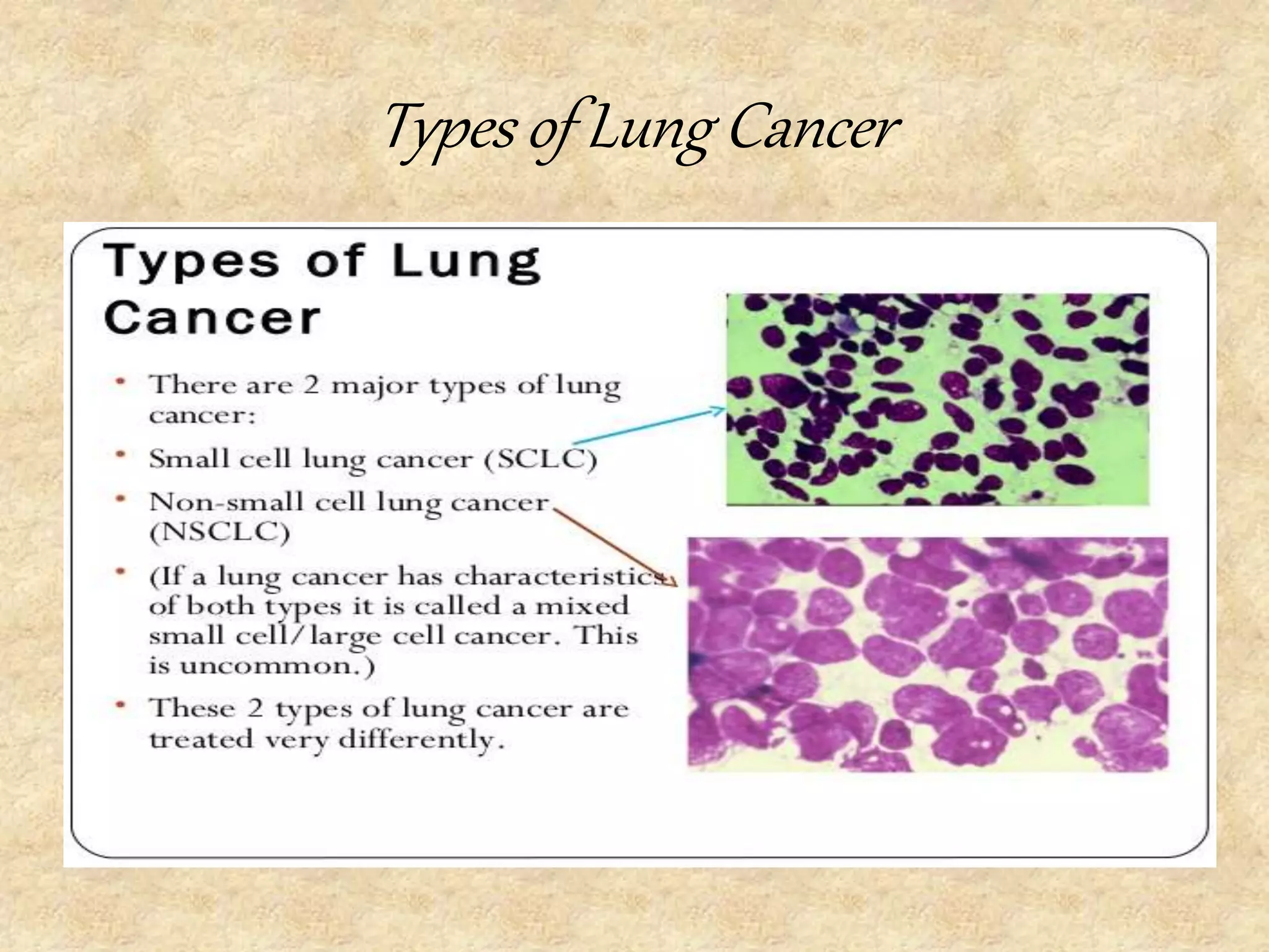 Lung cancer | PPTX | Lung and Respiratory Health | Diseases and Conditions