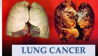 LUNG CANCER
 