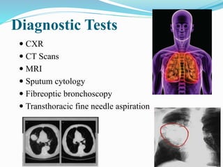 Diagnostic Tests
 CXR
 CT Scans
 MRI
 Sputum cytology
 Fibreoptic bronchoscopy
 Transthoracic fine needle aspiration
 