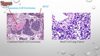 Combined Small Cell Carcinoma Small Cell Lung Cancer
Squamous Cell Carcinoma
SCLC
 