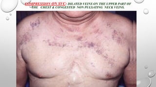 COMPRESSION ON SVC: DILATED VEINS ON THE UPPER PART OF
THE CHEST & CONGESTED NON PULSATING NECK VEINS.
 
