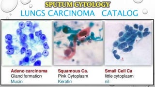 LUNGS CARCINOMA CATALOG
 