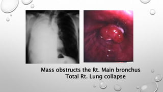 Mass obstructs the Rt. Main bronchus
Total Rt. Lung collapse
 
