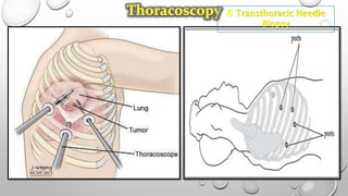 & Transthoracic Needle
Biopsy
 