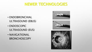 NEWER TECHNOLOGIES
• ENDOBRONCHIAL
ULTRASOUND (EBUS)
• ENDOSCOPIC
ULTRASOUND (EUS)
• NAVIGATIONAL
BRONCHOSCOPY
 