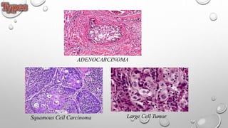 ADENOCARCINOMA
Squamous Cell Carcinoma Large Cell Tumor
 