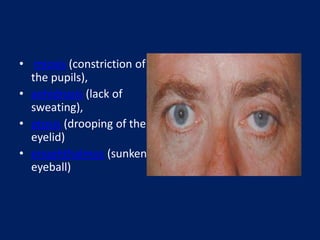 • miosis (constriction of
the pupils),
• anhidrosis (lack of
sweating),
• ptosis (drooping of the
eyelid)
• enophthalmos (sunken
eyeball)
 