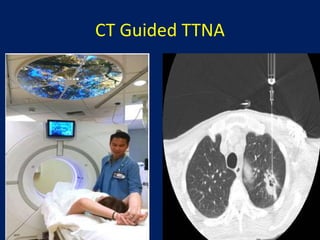 CT Guided TTNA
 