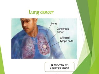Lung cancer
PRESENTED BY:
ABHAY RAJPOOT
 