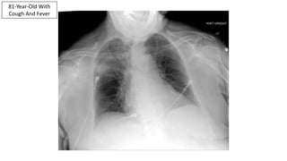 81-Year-Old With
Cough And Fever
 