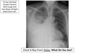 79 Year Old Male
Smoker Presents
With Cough And
Two Weeks Of Right
Sided Chest Pain.
Chest X-Ray From Today: What Do You S...