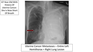 Uterine Cancer Metastases – Entire Left
Hemithorax + Right Lung Lesion
67-Year-Old With
History Of
Uterine Cancer.
She Is ...