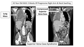 43 Year Old With 3 Weeks Of Progressive Right Arm & Neck Swelling.
Lung
Mass
Compressed
Superior
Vena Cava
Biopsy = Melano...