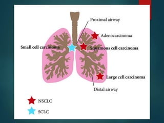 肺癌分類
占比 起源部位 生長速度 與吸菸者關
係
手術切
除
特點
小細胞肺癌
(SCLC)
8-10% 呼吸道中
央
快速,容易
轉移
與抽菸有極
高度相關性
無法 有腫瘤伴
隨症候群*
非小細胞肺癌
(NSCLC)
90-
92%
都有可...