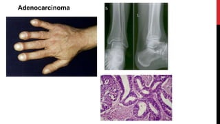 Adenocarcinoma
 