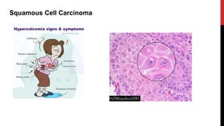 Squamous Cell Carcinoma
 