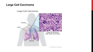 Large Cell Carcinoma
 