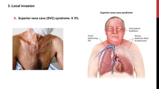 3. Local invasion
A. Superior vena cava (SVC) syndrome  5%
 
