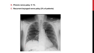 B. Phrenic nerve palsy  1%
C. Recurrent laryngeal nerve palsy (3% of patients)
 