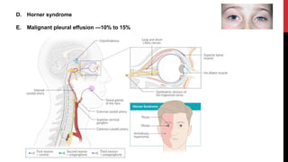 D. Horner syndrome
E. Malignant pleural effusion —10% to 15%
 