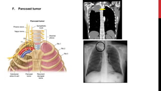 F. Pancoast tumor
 