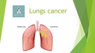 Lungs cancer
 