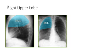 Right Upper Lobe
 