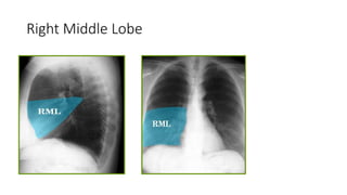 Right Middle Lobe
 