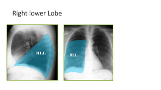 Right lower Lobe
 