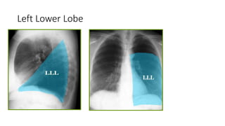 Left Lower Lobe
 