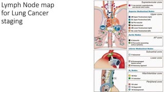 Lymph Node map
for Lung Cancer
staging
 