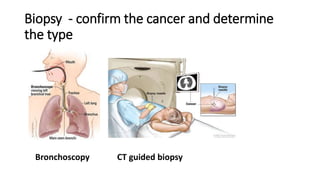 Biopsy - confirm the cancer and determine
the type
Bronchoscopy CT guided biopsy
 