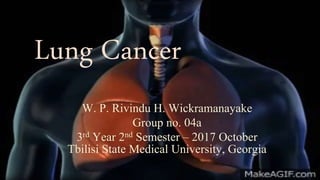 Lung Cancer
W. P. Rivindu H. Wickramanayake
Group no. 04a
3rd Year 2nd Semester – 2017 October
Tbilisi State Medical University, Georgia
 