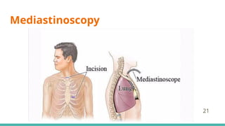 Mediastinoscopy
21
 