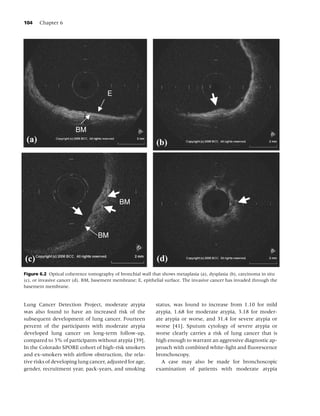 104    Chapter 6




                                      E




                        BM
 (a)                                                         (b)




                                            BM



                                  BM


(c)                                                          (d)
Figure 6.2 Optical coherence tomography of bronchial wall that shows metaplasia (a), dysplasia (b), carcinoma in situ
(c), or invasive cancer (d). BM, basement membrane; E, epithelial surface. The invasive cancer has invaded through the
basement membrane.


Lung Cancer Detection Project, moderate atypia               status, was found to increase from 1.10 for mild
was also found to have an increased risk of the              atypia, 1.68 for moderate atypia, 3.18 for moder-
subsequent development of lung cancer. Fourteen              ate atypia or worse, and 31.4 for severe atypia or
percent of the participants with moderate atypia             worse [41]. Sputum cytology of severe atypia or
developed lung cancer on long-term follow-up,                worse clearly carries a risk of lung cancer that is
compared to 3% of participants without atypia [39].          high enough to warrant an aggressive diagnostic ap-
In the Colorado SPORE cohort of high-risk smokers            proach with combined white-light and ﬂuorescence
and ex-smokers with airﬂow obstruction, the rela-            bronchoscopy.
tive risks of developing lung cancer, adjusted for age,         A case may also be made for bronchoscopic
gender, recruitment year, pack-years, and smoking            examination of patients with moderate atypia
 
