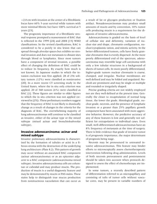 Pathology and Pathogenesis of Adenocarcinoma         125


<2.0 cm with invasion at the center of a ﬁbroblastic        a result of fat or glycogen production or ﬁxation
focus have 60% 5-year survival while tumors with            artifact. Nonadenocarcinomas may produce small
more minimal ﬁbrotic foci have 100% survival at 5           amounts of mucin and by convention, 10% tumor
years [23].                                                 cells producing mucin is a requirement for the di-
   The prognostic importance of a ﬁbroblastic stro-         agnosis of invasive adenocarcinoma.
mal response prompted a reassessment of BAC that               Adenocarcinoma is graded on the basis of level
is reﬂected in the 1999 [24] and 2004 [15] WHO              of cellular size and deformity, variation of nu-
classiﬁcations. In the revised classiﬁcations, BAC is       clear size and shape, chromatin conﬁguration, nu-
considered to be a purely in situ lesion that can           clear/cytoplasmic ration, and mitotic activity. In the
spread through alveolar spaces but exhibits no stro-        better-differentiated tumors, cells have ﬁnely gran-
mal invasion and does not metastasis to distant sites       ular chromatin that is evenly dispersed. At the more
through blood or lymphatics. Since most tumors              poorly differentiated end of the spectrum, adeno-
have a component of stromal invasion, a possible            carcinoma may resemble large cell carcinoma with
effect of changing the deﬁnition of BAC could be            only a few tubular structures in a background of
to reduce its frequency. By exactly how much is             sheets of tumor cells. In more poorly differentiated,
not known. In Japanese studies in which the in-             higher-grade tumors nuclear chromatin is coarse,
vasion exclusion was ﬁrst applied, 28 of 236 soli-          clumped, and irregular. Nuclear membranes are
tary tumors (12%) were classiﬁed as noninvasive             well deﬁned and may be folded and angulated. Nu-
[20]. In a more recent CT screening study in the            cleoli are prominent and may be single or multiple
United States, where the in situ only criterion was         and rounded or irregularly shaped.
applied, 20 of 348 tumors (6%) were classiﬁed as               Precise grading criteria are not widely employed
BAC [1]. These ﬁgures are similar to older ﬁgures           nor are they well deﬁned at the present time. Gen-
to which the in situ criterion was not applied (re-         erally the closer to recapitulation of normal lung
viewed in [25]). These preliminary numbers suggest          tissue, the lower the grade. Histological grade, nu-
that the frequency of BAC is not likely to drastically      clear grade, necrosis, and the presence of lymphatic
change as a result of changes in the criteria for the       invasion or a greater than 25% papillary growth
diagnosis of BAC. The overwhelming majority of              component have been associated with more aggres-
lung adenocarcinomas will continue to be classiﬁed          sive behavior. However, the predictive accuracy of
as invasive, either of the acinar type or the mixed         any of these features is low and generally not suf-
subtype (mixed acinar and bronchioloalveolar                ﬁcient for extrapolation to individual cases. Even
subtype).                                                   small, well-differentiated adenocarcinomas have an
                                                            8% frequency of metastasis at the time of surgery.
Invasive adenocarcinoma: acinar and                         There is little evidence that grade of invasive tumor
mixed subtype                                               is of prognostic importance, the major determinant
Invasive pulmonary adenocarcinoma is character-             of prognosis being stage.
ized by the formation of tubules or acini in a ﬁ-              Necrosis may be pronounced in untreated in-
brous stroma with the destruction of the underlying         vasive adenocarcinomas. This feature may hinder
lung architecture (Plate 8.2). This pattern of growth       efforts to microscopically assess chemotherapeutic
may occur without an associated BAC component               intervention following drug administration. Levels
(acinar adenocarcinoma) or as an epicenter adja-            of both necrosis pretreatment and posttreatment
cent to a BAC component (adenocarcinoma mixed               should be taken into account when protocols de-
subtype). Invasive adenocarcinoma cells are colum-          signed to assess the effect of chemotherapy are im-
nar or cuboidal and may produce mucin. The pro-             plemented.
duction of mucin is a useful diagnostic feature and            In some tumors, a recently described pattern
may be demonstrated by mucin or PAS stains. These           of differentiation referred to as micropapillary and
stains help to distinguish true mucus production            consisting of tufts of tumor cells without vascu-
from nonmucinous vacuolation that can occur as              lar cores, may be present in variable numbers of
 