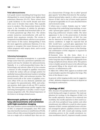 128   Chapter 8


Fetal adenocarcinoma                                    ate a characteristic CT image, the so-called “ground
Low-grade tumors resembling fetal lung have been        glass opacity” [61] (Plate 8.8) [62,63]. The small pe-
distinguished in recent decades from higher-grade       ripheral ground glass opacity is often a presenting
pulmonary blastoma [53–57]. These tumors have           feature of BAC and is one of three major patterns
a peak incidence in the fourth decade and more          of spread recognizable on CT scans described below
often occur in females than males. They typically       and reviewed in [64].
occur in smokers. The characteristic feature of this    1 Solitary mass or nodule. Nodules may be “solid,”
tumor is the formation of tubules by glycogen-          obscuring of the underlying lung markings, or non-
rich cells that resemble fetal bronchial tubes at 10–   solid (“ground glass opacity”) in which the under-
15 weeks gestational age (Plate 8.6). The tubules       lying lung architecture remains visible. The latter
contain numerous neuroendocrine cells and fre-          appearance is due to the preservation of alveolar
quently form squamous morules. The stroma is            air spaces and is characteristic of BAC but may
composed of myoﬁbroblastic cells but is not a promi-    also be observed in non-BAC tumors and inﬂam-
nent feature of this tumor, distinguishing it from      matory conditions. It might be expected that all
the more aggressive pulmonary blastoma. It is im-       BAC would have a ground glass appearance but
portant to recognize this tumor because of its ex-      the phenomenon of collapse causes partial or com-
cellent prognosis with surgery alone, and to avoid      plete opaciﬁcation of tumor tissue so that histolog-
overtreatment.                                          ical conﬁrmation of BAC diagnosis is required for
                                                        deﬁnitive diagnosis.
                                                        2 Pneumonic form. In this form, there is a
Sclerosing hemangioma
                                                        pneumonia-like consolidation of a segment, lobe or
Pulmonary sclerosing hemangioma is a generally
                                                        entire lung that may be difﬁcult to distinguish from
benign tumor that has a prominent epithelial com-
                                                        benign peripheral airway disease [65]. This pattern
ponent and may be mistaken for adenocarcinoma.
                                                        is due to lepidic spread of tumor in the affected lung
Typically, it is a well-circumscribed lesion that is
                                                        and partial ﬁlling of the alveoli with tumor cells,
hemorrhagic and sclerotic (Plate 8.7a) but contains
                                                        mucous, or inﬂammatory cells.
a mixture of cells arranged in papillary structures
                                                        3 Diffuse BAC. Diffuse BAC appears as nodular solid
in which the surface cells are strongly positive for
                                                        or ground glass opacities throughout the lungs. This
epithelial immunohistochemical markers including
                                                        form of the disease is rare.
pancytokeratin, EMA, and surfactant proteins. The
central round cells at the center of papillary struc-   In general, while imaging studies may be suggestive
tures (Plate 8.7b) are less distinctly epithelial and   of BAC, deﬁnitive diagnosis continues to depend on
are negative for pancytokeratin, EMA, and surfac-       histological conﬁrmation.
tant proteins. Both types of cells are TTF-1 positive
[58]. This immunophenotype proﬁle suggests that
                                                        Cytology of BAC
sclerosing hemangioma is actually a tumor of pul-
                                                        BAC, because of its peripheral location, is rarely de-
monary progenitor cells. The clinical importance of
                                                        tected during early stages in sputum. The main ap-
the lesion is its benign clinical course.
                                                        plication for cytology in the diagnosis of BAC is in
                                                        ﬁne needle aspiration. Because of its relatively low
Macroscopic patterns of peripheral                      morbidity, ﬁne needle aspiration is often used to ac-
lung adenocarcinoma and correlation                     cess cells from peripheral lung nodules and other
with high-resolution imaging                            intrathoracic sites difﬁcult to reach by other means.
The most sensitive current method for the detection     Aspirates of BAC contain epithelial tumor cell clus-
of BAC is computed tomography since PET scans           ters arranged in spheres, papillary clusters or sheets
may miss heavily mucinous or small lesions [59,60].     of uniform cells with round pale-staining nuclei
Tumor cells are often arrayed along the alveolar sep-   containing grooves in the usually prominent nu-
tum as a single cell or multicell layer that can cre-   clear membranes [66,67]. Aspirates usually contain
 
