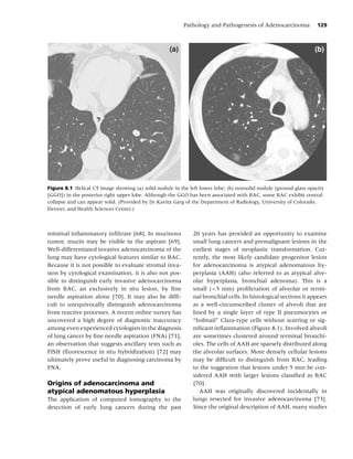 Pathology and Pathogenesis of Adenocarcinoma             129



                                                    (a)                                                           (b)




Figure 8.1 Helical CT image showing (a) solid nodule in the left lower lobe; (b) nonsolid nodule (ground glass opacity
[GGO]) in the posterior right upper lobe. Although the GGO has been associated with BAC, some BAC exhibit central
collapse and can appear solid. (Provided by Dr Kavita Garg of the Department of Radiology, University of Colorado,
Denver, and Health Sciences Center.)



minimal inﬂammatory inﬁltrate [68]. In mucinous               20 years has provided an opportunity to examine
tumor, mucin may be visible in the aspirate [69].             small lung cancers and premalignant lesions in the
Well-differentiated invasive adenocarcinoma of the            earliest stages of neoplastic transformation. Cur-
lung may have cytological features similar to BAC.            rently, the most likely candidate progenitor lesion
Because it is not possible to evaluate stromal inva-          for adenocarcinoma is atypical adenomatous hy-
sion by cytological examination, it is also not pos-          perplasia (AAH) (also referred to as atypical alve-
sible to distinguish early invasive adenocarcinoma            olar hyperplasia, bronchial adenoma). This is a
from BAC, an exclusively in situ lesion, by ﬁne               small (<5 mm) proliferation of alveolar or termi-
needle aspiration alone [70]. It may also be difﬁ-            nal bronchial cells. In histological sections it appears
cult to unequivocally distinguish adenocarcinoma              as a well-circumscribed cluster of alveoli that are
from reactive processes. A recent online survey has           lined by a single layer of type II pneumocytes or
uncovered a high degree of diagnostic inaccuracy              “hobnail” Clara-type cells without scarring or sig-
among even experienced cytologists in the diagnosis           niﬁcant inﬂammation (Figure 8.1). Involved alveoli
of lung cancer by ﬁne needle aspiration (FNA) [71],           are sometimes clustered around terminal bronchi-
an observation that suggests ancillary tests such as          oles. The cells of AAH are sparsely distributed along
FISH (ﬂuorescence in situ hybridization) [72] may             the alveolar surfaces. More densely cellular lesions
ultimately prove useful in diagnosing carcinoma by            may be difﬁcult to distinguish from BAC, leading
FNA.                                                          to the suggestion that lesions under 5 mm be con-
                                                              sidered AAH with larger lesions classiﬁed as BAC
Origins of adenocarcinoma and                                 [70].
atypical adenomatous hyperplasia                                 AAH was originally discovered incidentally in
The application of computed tomography to the                 lungs resected for invasive adenocarcinoma [73].
detection of early lung cancers during the past               Since the original description of AAH, many studies
 