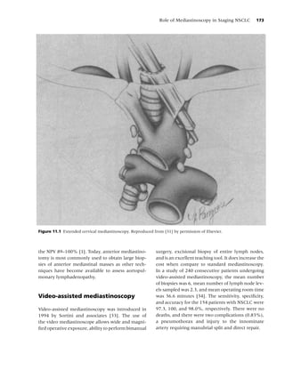Role of Mediastinoscopy in Staging NSCLC          173




Figure 11.1 Extended cervical mediastinoscopy. Reproduced from [31] by permission of Elsevier.




the NPV 89–100% [1]. Today, anterior mediastino-            surgery, excisional biopsy of entire lymph nodes,
tomy is most commonly used to obtain large biop-            and is an excellent teaching tool. It does increase the
sies of anterior mediastinal masses as other tech-          cost when compare to standard mediastinoscopy.
niques have become available to assess aortopul-            In a study of 240 consecutive patients undergoing
monary lymphadenopathy.                                     video-assisted mediastinoscopy, the mean number
                                                            of biopsies was 6, mean number of lymph node lev-
                                                            els sampled was 2.3, and mean operating room time
Video-assisted mediastinoscopy                              was 36.6 minutes [34]. The sensitivity, speciﬁcity,
                                                            and accuracy for the 154 patients with NSCLC were
Video-assisted mediastinoscopy was introduced in            97.3, 100, and 98.0%, respectively. There were no
1994 by Sortini and associates [33]. The use of             deaths, and there were two complications (0.83%),
the video mediastinoscope allows wide and magni-            a pneumothorax and injury to the innominate
ﬁed operative exposure, ability to perform bimanual         artery requiring manubrial split and direct repair.
 