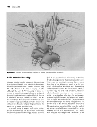 174    Chapter 11




Figure 11.2 Anterior mediastinotomy. Reproduced from [31] by permission of Elsevier.


Redo mediastinoscopy                                       [38]. It was possible to obtain a biopsy at the same
                                                           level that was positive at the initial mediastinoscopy.
Multiple studies utilizing induction chemotherapy          There were no complications other than a wound
or chemoradiotherapy have documented increased             infection. Of the 12 patients found to be N2 neg-
survival in the subset of N2 patients found to have        ative, 5 had residual N2 disease after thoracotomy
N0 or N1 disease at the time of surgery [35–37].           and lymphadenectomy. The sensitivity for redo me-
Although the use of PET scanning to assess re-             diastinoscopy was 0.70 and accuracy 0.80. It was
sponse to induction therapy is being investigated,         admitted that the technique was more complex sec-
histopathologic conﬁrmation of residual N2 disease         ondary to peritracheal adhesions. The authors em-
is required if alternate therapies to surgery are be-      phasized digital dissection and gradual access cre-
ing considered. Most surgeons are fearful of redo          ated by using the electrocautery. It was noted that
mediastinoscopy secondary to expected ﬁbrosis and          the mediastinoscope was more easily inserted via
difﬁculty reaching the original biopsy site and the        the left side of the trachea. Dissection to create a
danger of increased complications.                         left paratracheal tunnel until the posterior arch of
   In a small study of patients undergoing neoad-          the aorta is reached is also emphasized in a series
juvant chemotherapy for N2 disease, 24 patients            reported by Van Schil and associates [39]. Dissec-
underwent redo mediastinoscopy to assess response          tion using the suction tip is then carried back to the
 