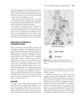 Role of Mediastinoscopy in Staging NSCLC           175


mid line and right side of the trachea. Bleeding con-
trolled by tamponade was encountered in two of 27                                  1
patients. The accuracy of redo mediastinoscopy in
this series was 85%. It was noted that subcarinal
nodes were the most difﬁcult to reach.
                                                                               2        2
   Video-assisted mediastinoscopy has also been
successfully used in the postinduction setting [40].                                        Aortic arch
The anticipated increased difﬁculty when radiother-
apy is added requires further evaluation.
   Although redo mediastinoscopy is feasible, the                              4        4        5
use of alternate minimally invasive techniques to
evaluate the mediastinum offers a simpler and less                         10               10
                                                                    12
risky method to reassess the postinduction medi-                                   7
astinum. Although limited by ﬁne-needle aspira-
                                                                      11
tions, the level of initial positivity can always easily                                             11
be rebiopsied and multiple procedures are possible.
                                                                                   8
                                                                               Esaphagus
Alternative methods to                                                                                    12
mediastinoscopy                                                            9                9

                                                                         Pulmonary ligament
Both endobronchial ultrasonography (EBUS) and
esophageal endoscopic ultrasonography (EUS) al-
low excellent visualization of the mediastinum. By                              EBUS-TBNA
adding real-time ﬁne-needle aspiration (FNA) to
both techniques, histologic conﬁrmation of medi-
astinal disease can be obtained in an outpatient                                EUS-FNA
setting with conscious sedation, and even minor
complications are rare (i.e., these methods are min-       Figure 11.3 The diagnostic reach of EUS-FNA and
imally invasive). As shown in Figure 11.3, the diag-       EBUS-FNA (TBNA).(Reproduced with permission from
nostic reach of EBUS-FNA and EUS-FNA is com-               Elsevier.)
plementary [41]. EUS-FNA allows access to the
retrotracheal space (level 3), the lower paratracheal
region on the left (4L), the radiographic subaortic        PET in the posterior mediastinum, the sensitivity
space (5), and the posterior mediastinum (levels 7,        ranged from 92.5 to 96% and accuracy has been
8, and 9). EBUS-FNA provides access to the superior        97–98% [43,44].
mediastinum (levels 2R, 2L, 4R, 4L), the subcarinal           EUS-FNA can prevent up to 70% of invasive
space (7), as well as hilar (10), interlobar (11) and      staging in patients with radiographic evidence of
lobar (12) lymph node levels.                              N2/N3 disease [45,46] and therefore can clearly im-
                                                           pact on patient management [47]. The utility of
EUS-FNA                                                    EUS-FNA in the setting of a radiographic negative
In a large series of 242 consecutive patients with         mediastinum has yet to be clariﬁed. In a study by
suspected or proven NSCLC and enlarged (>1 cm              Wallace and associates [48], a small cohort of pa-
short-axis diameter) lymph nodes by CT, the sen-           tients (n = 24) without enlarged mediastinal lymph
sitivity, speciﬁcity, and accuracy for EUS in medi-        nodes underwent EUS-FNA and a surprising 42%
astinal analysis were 91, 100, and 93%, respectively       had stage III or IV disease detected by EUS. In a study
[42]. In patients with suspicious nodes by CT and/or       speciﬁcally assessing EUS-FNA in the CT-negative
 