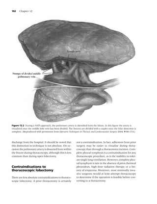 182    Chapter 12




Figure 12.2 During a VATS approach, the pulmonary artery is identiﬁed from the hilum. In this ﬁgure the artery is
visualized once the middle lobe vein has been divided. The ﬁssures are divided with a stapler once the hilar dissection is
complete. (Reproduced with permission from Operative Techniques in Thoracic and Cardiovascular Surgery 2004; 9:98–114.)



discharge from the hospital. It should be noted that           not a contraindication. In fact, adhesions from prior
this distinction in technique is not absolute. On oc-          surgery may be easier to visualize during thora-
casion the pulmonary artery is dissected from within           coscopy than through a thoracotomy incision. Com-
the ﬁssure during thoracoscopy, although this is less          plete pleural symphysis is a contraindication for any
common than during open lobectomy.                             thoracoscopic procedure, as is the inability to toler-
                                                               ate single lung ventilation. However, complete pleu-
                                                               ral symphysis is rare in the absence of prior chemical
Contraindications to                                           pleurodesis, high-dose radiation therapy or a his-
thoracoscopic lobectomy                                        tory of empyema. Moreover, most minimally inva-
                                                               sive surgeons would at least attempt thoracoscopy
There are few absolute contraindications to thoraco-           to determine if the operation is feasible before con-
scopic lobectomy. A prior thoracotomy is certainly             verting to a thoracotomy.
 